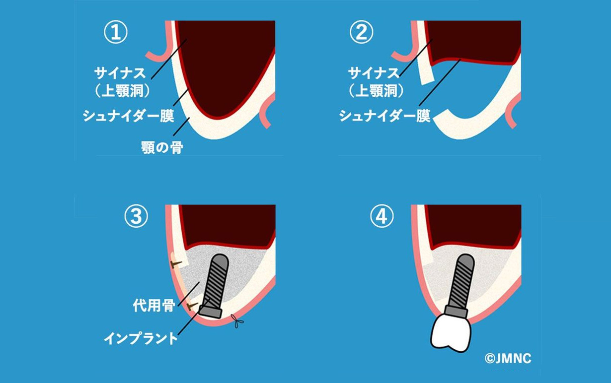 サイナスリフト