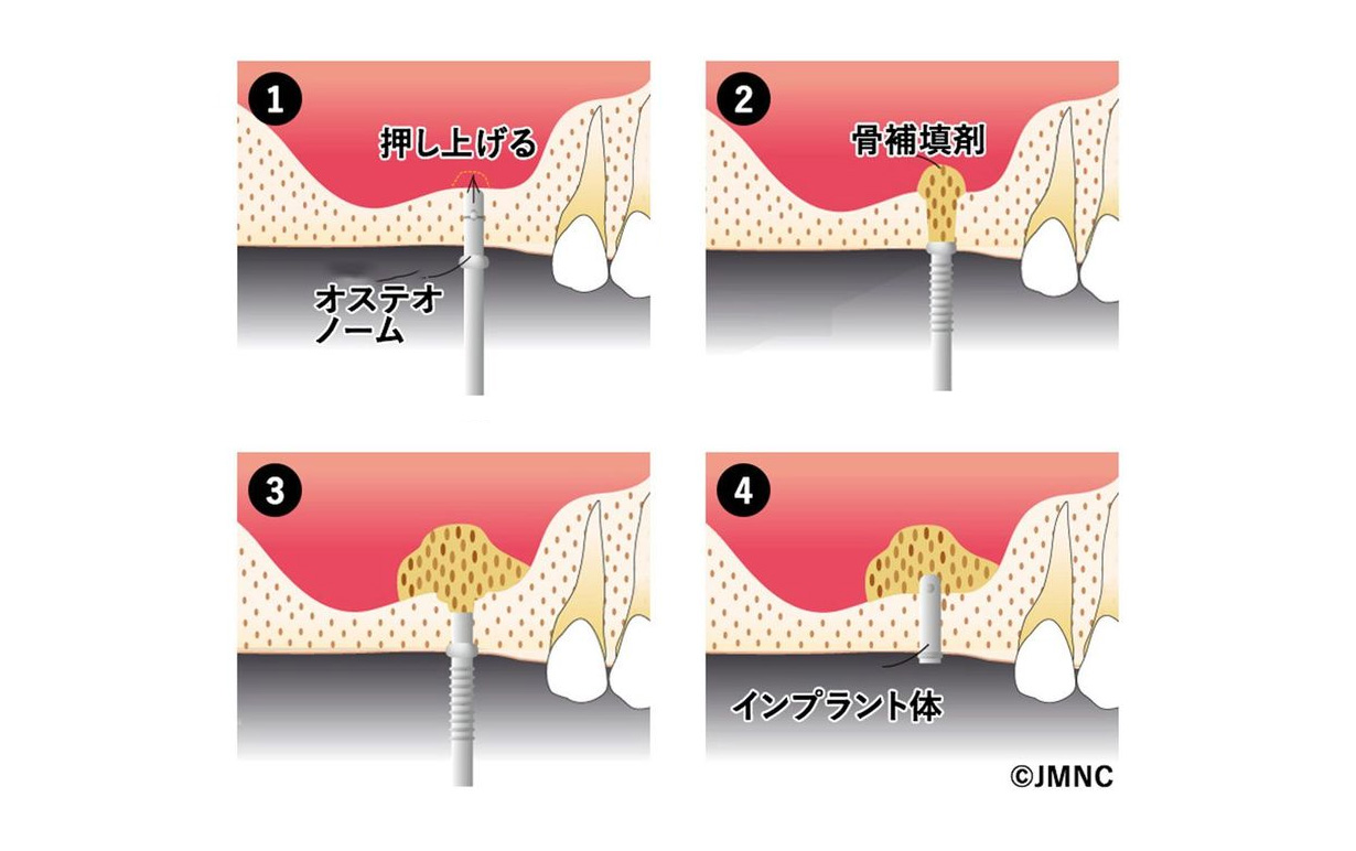 ソケットリフト