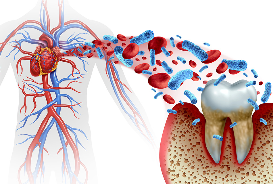 歯周病と全身疾患