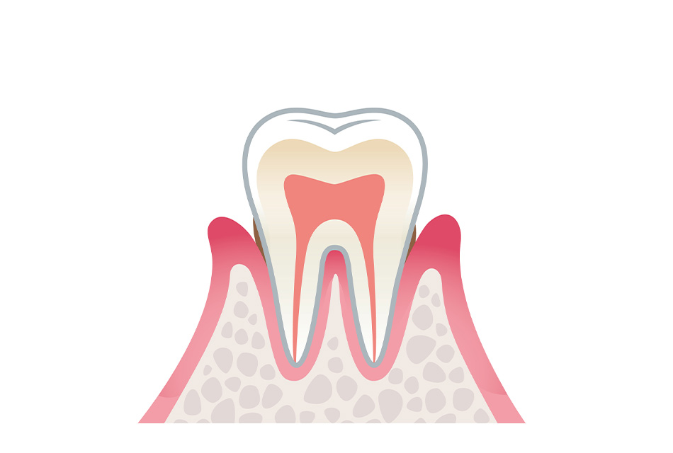 歯周炎（軽度）