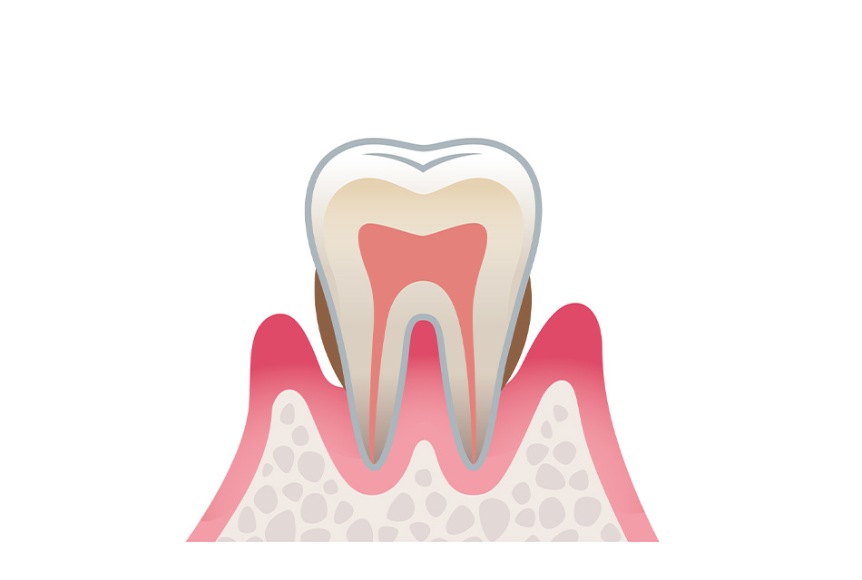 歯周炎（中度）