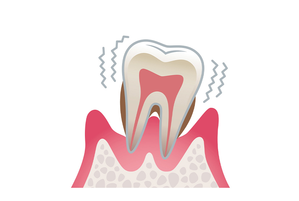 歯周炎（重度）